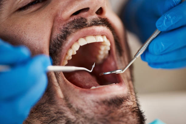 Best Dental Fillings (Composite and Amalgam)  in Lake Cassidy, WA